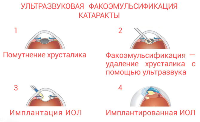 Ультразвуковая факоэмульсификация катаракты