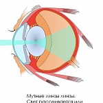 Катаракта