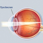 ПРЕСБИОПИЯ