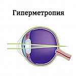 Гиперметропия