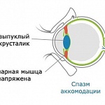 Cпазм аккомодации
