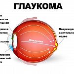 Глаукома